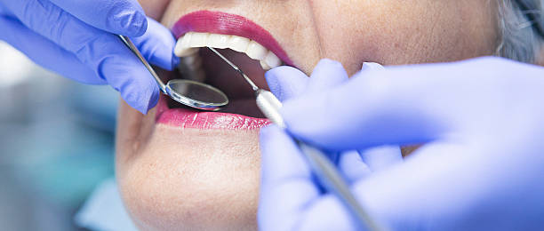 Best Knocked-Out Tooth (Avulsed Tooth) Treatment in La Honda, CA